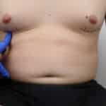 Gynecomastia in Dublin: Causes, Options and What to Expect