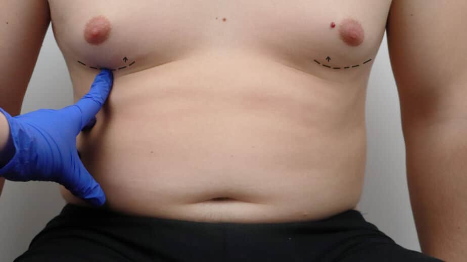 Gynecomastia in Dublin: Causes, Options and What to Expect