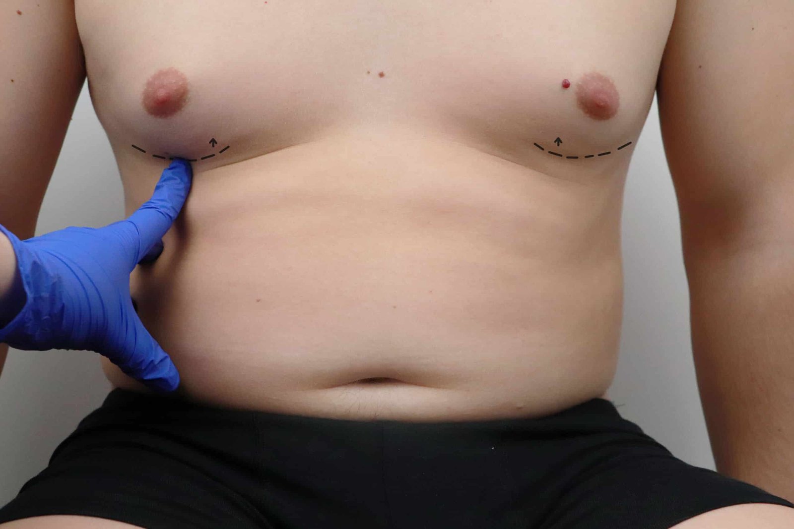 Gynecomastia in Dublin: Causes, Options and What to Expect