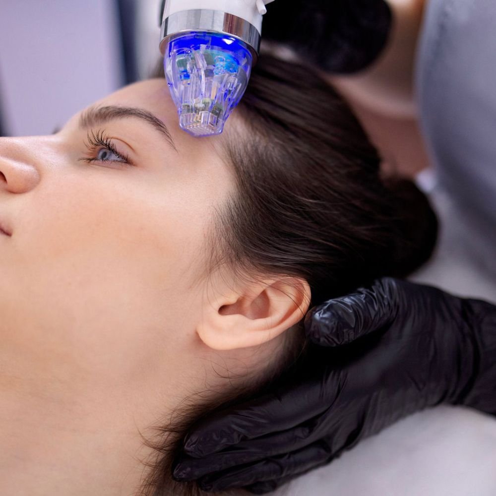RF Microneedling Dublin Ireland