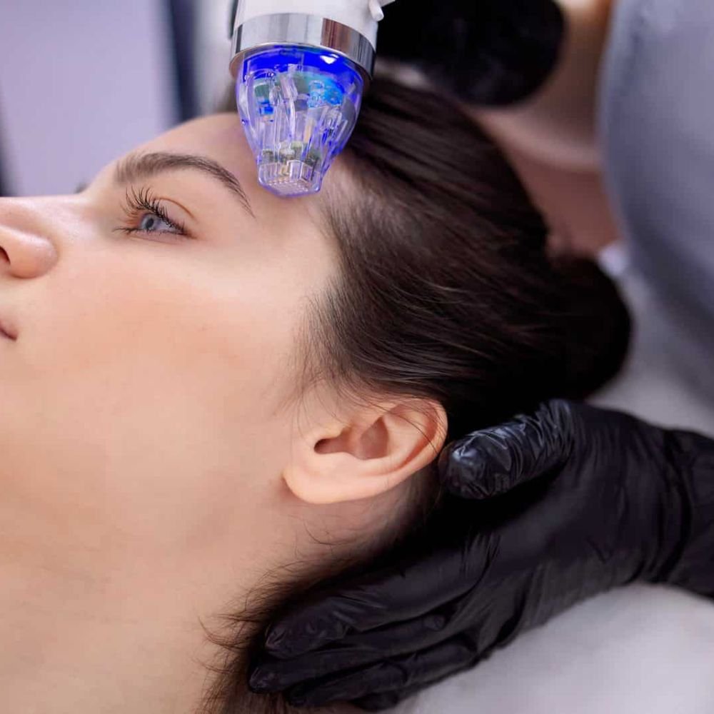 RF Microneedling Dublin Ireland